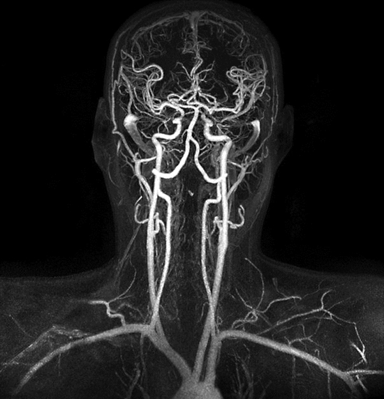 磁共振血管造影 脑部图片
